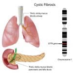 Cystischen-Fibrose
