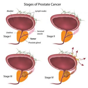 Stadien Prostatakrebs